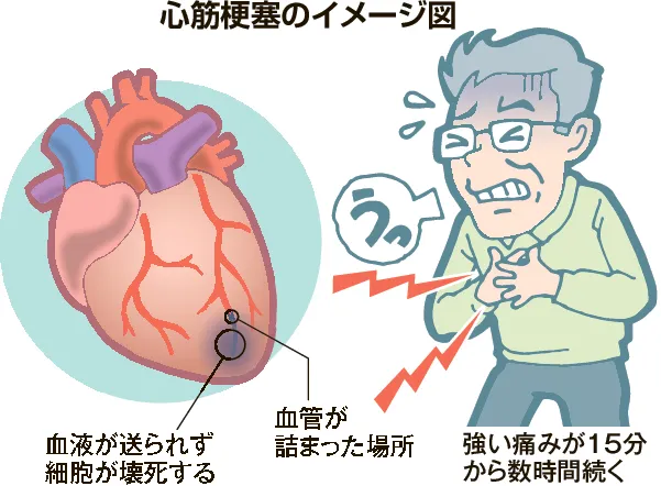 心臓と除細動｜着用型自動除細動器（WCD）｜旭化成ゾール