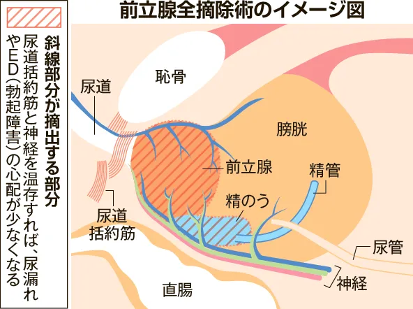前立腺全摘除、術後改善に期待 尿漏れ→ロボット活用、機能温存 ＥＤ→注射や衝撃波、血流回復：北海道新聞デジタル